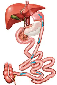 An illustration of how Biliopancreatic diversion and duodenal switch (dS) work.