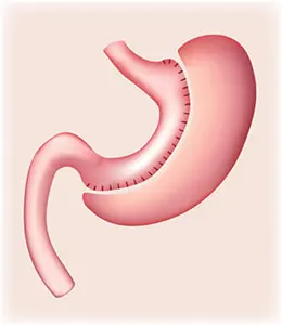 An illustration of how the stomach is altered.