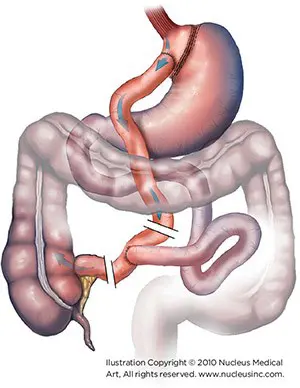 An illustration of a combination procedure.