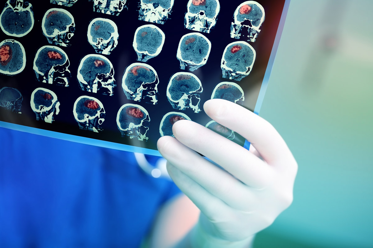 A physician wearing blue scrubs and a white glove holds up a scan of a brain that has red areas shaded to indicate a stroke.