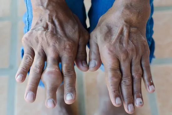 A person's hands with lots of swelling.