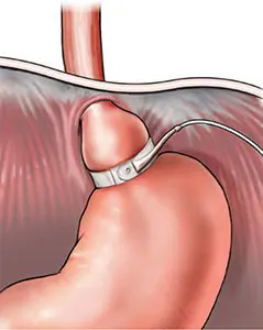 An illustration of Silastic Ring Gastroplasty
