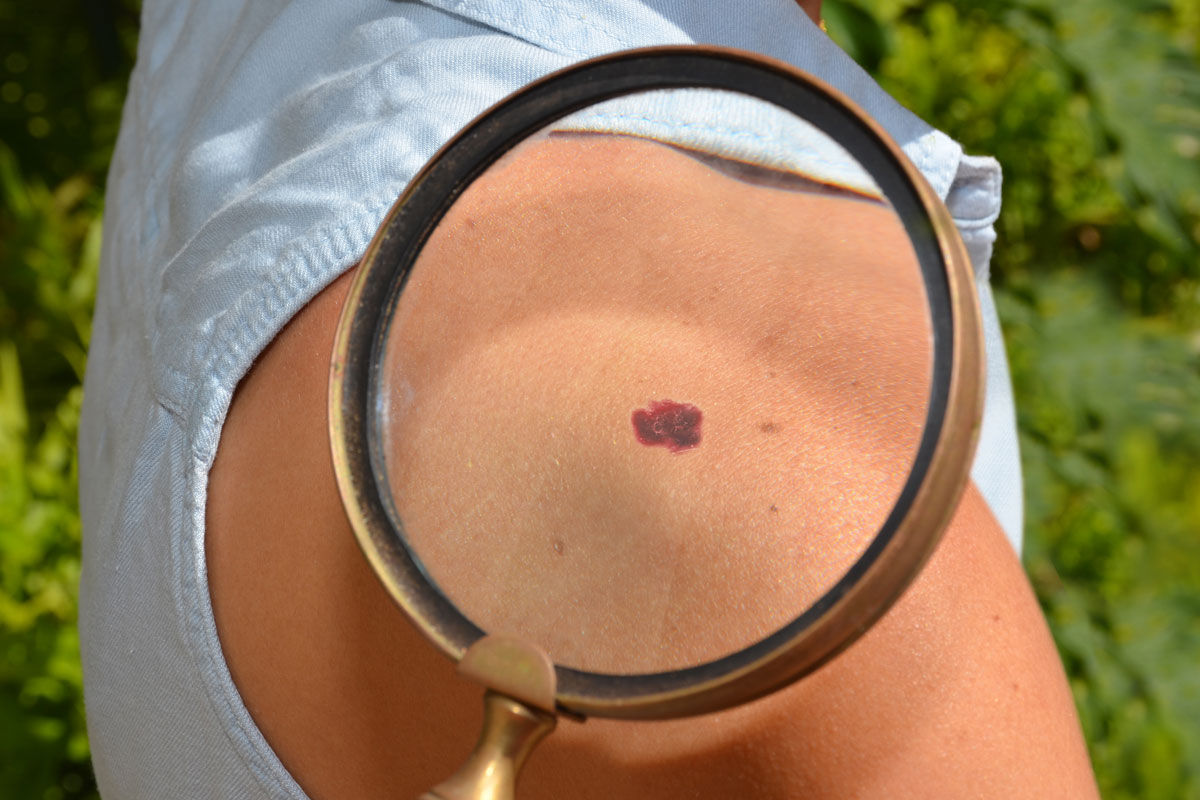 A magnified spot of patient's skin cancer.