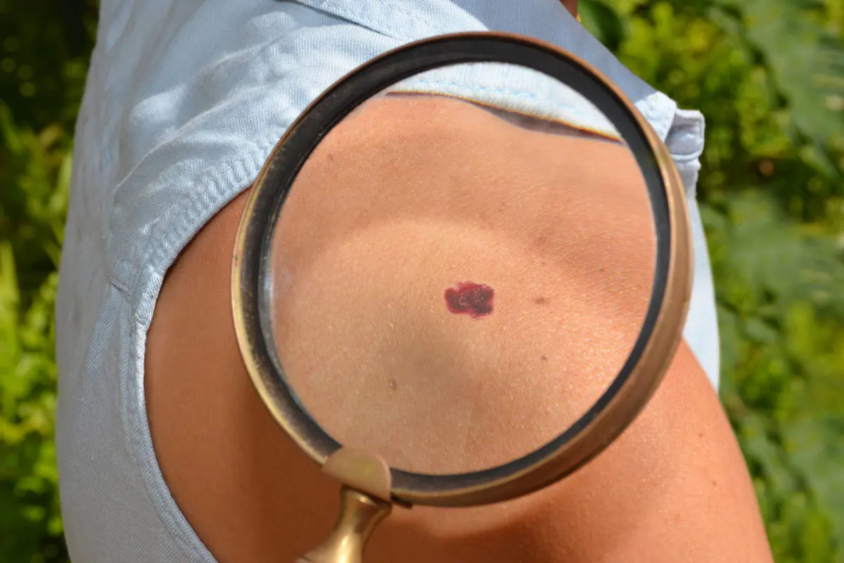 A magnified spot of patient's skin cancer.