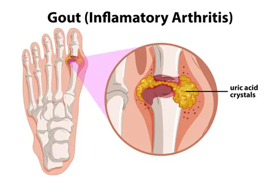 A medical illustration showing the uric acid crystals filling a toe joint.