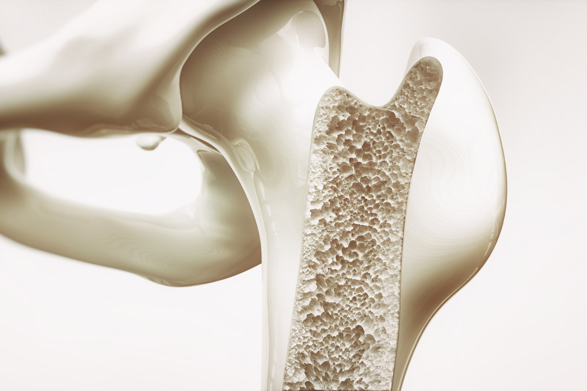 3-D image of bone with osteoporosis.