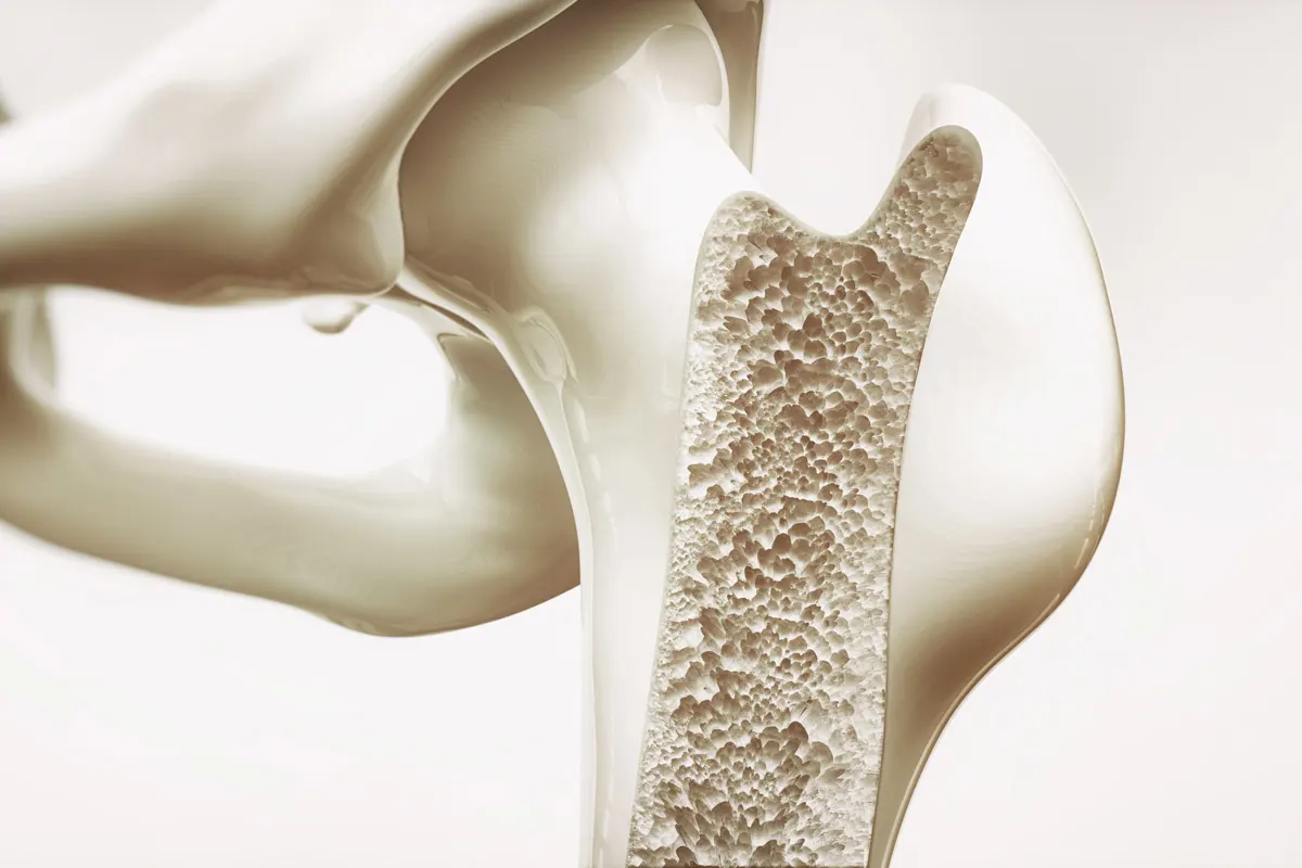 3-D image of bone with osteoporosis.
